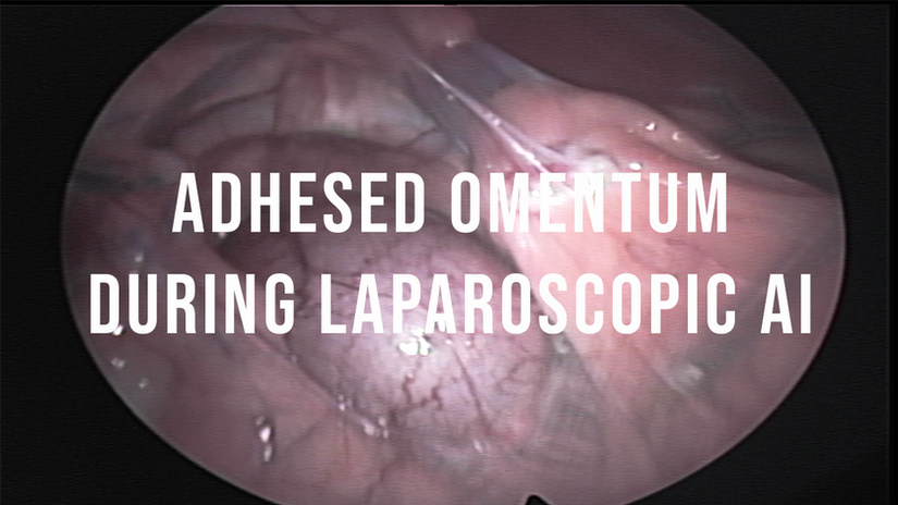 Adhesed omentum observed during sheep laparoscopic AI